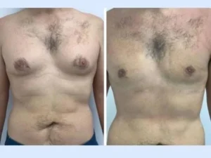 gynecomastia in Dubai