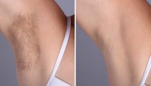 Electrolysis Laser hair removal in dubai