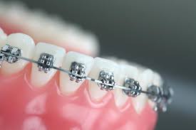Orthodontics Ma rket