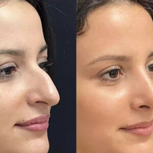 rhinoplasty in dubai
