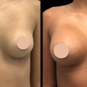 Best Breast Augmentation Surgeons in Dubai
