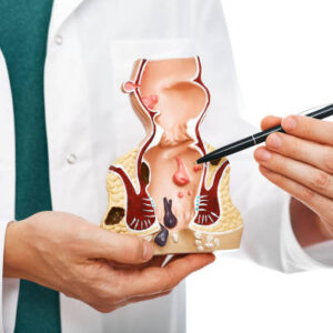 Hemorrhoid Treatement in Riyadh