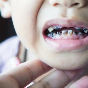 Is Sugar Really the Only Cause of Cavities in Kids