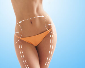 Liposuction in Riyadh 