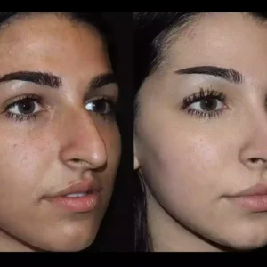 rhinoplasty in dubai