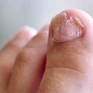 podiatrist and ingrown toenail