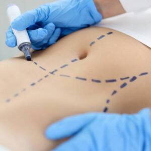 Tummy Tuck in Riyadh