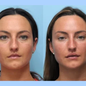 Silhouette Perfection: Best Plastic Surgeon in Dubai for Thread Lift Techniques
