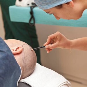 FUE Hair Transplant in Riyadh