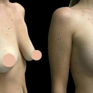 How to Choose the Right Surgeon for Breast Augmentation in Dubai