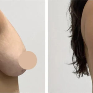 breast lift in dubai
