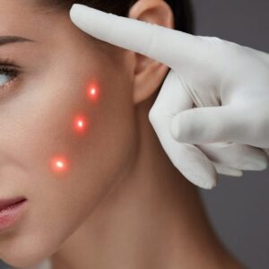Laser Hair Removal in Riyadh