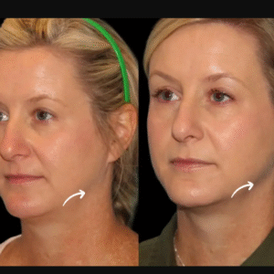 Sculptra Fillers in Dubai