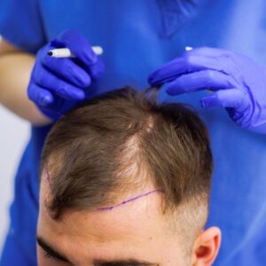 Hair Transplant in Riyadh