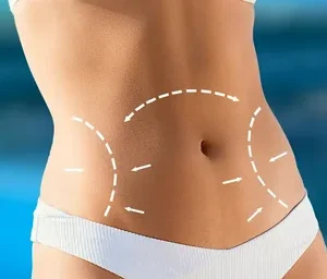 Liposuction in Riyadh