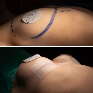 Breast reduction in Riyadh