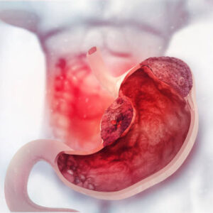Gastric Balloon in Riyadh