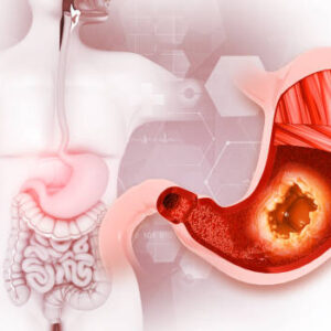 Gastric Balloon in Riyadh