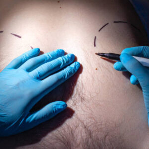 Gynecomastia in Riyadh
