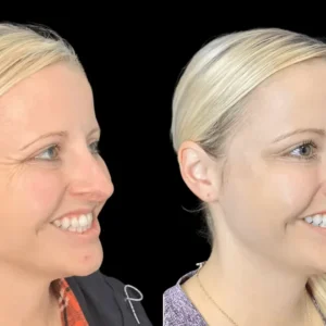 Botox in dubai