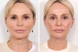 Thread Lift in Dubai vs. Traditional Facelift: Which Is Better for You