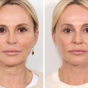 Thread Lift in Dubai vs. Traditional Facelift: Which Is Better for You