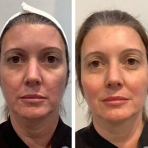 The Best Doctors in Dubai Explain Advanced Thread Lift Methods