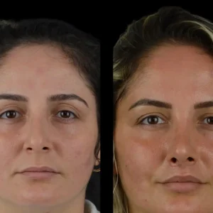Cheek Fillers in Dubai