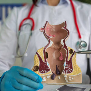 Safe Hemorrhoid Removal in Riyadh