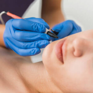 Electrolysis Sessions & Duration in Riyadh