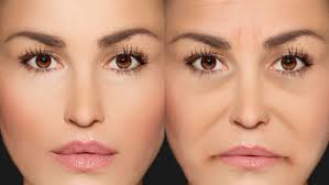 radiesse under eye