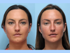 Thread Lift Wonders with the Best Plastic Surgeon in Dubai