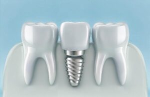 dental implant