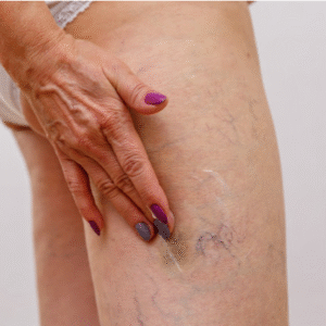 Varicose Veins