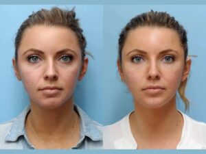 Global Trust Earned by Advanced Thread Lift Treatments in Dubai