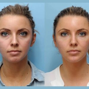 Global Trust Earned by Advanced Thread Lift Treatments in Dubai