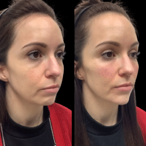 Non-surgical-Facelift