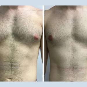 Is Financing Available for Gynecomastia in Dubai Procedures?