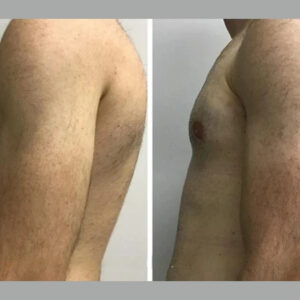 gynecomastia in dubai