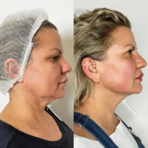 Painless Endolift Treatments in Dubai for Skin Rejuvenation
