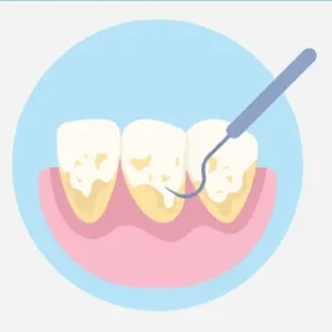 tooth abscess after root canal