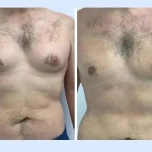 gynecomastia in Dubai