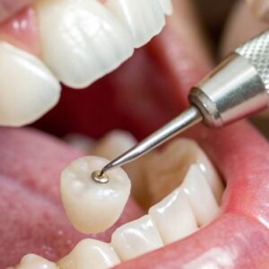Emergency Tooth Bonding in London: Quick Solutions for Chipped Teeth