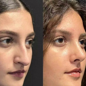Rhinoplasty in Dubai