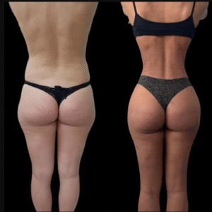 J-Plasma treatment in Dubai